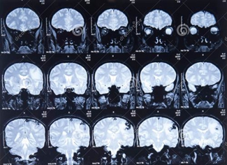 MRI常用術(shù)語(yǔ)（下）