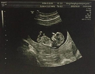 醫(yī)學(xué)影像學(xué)——B超