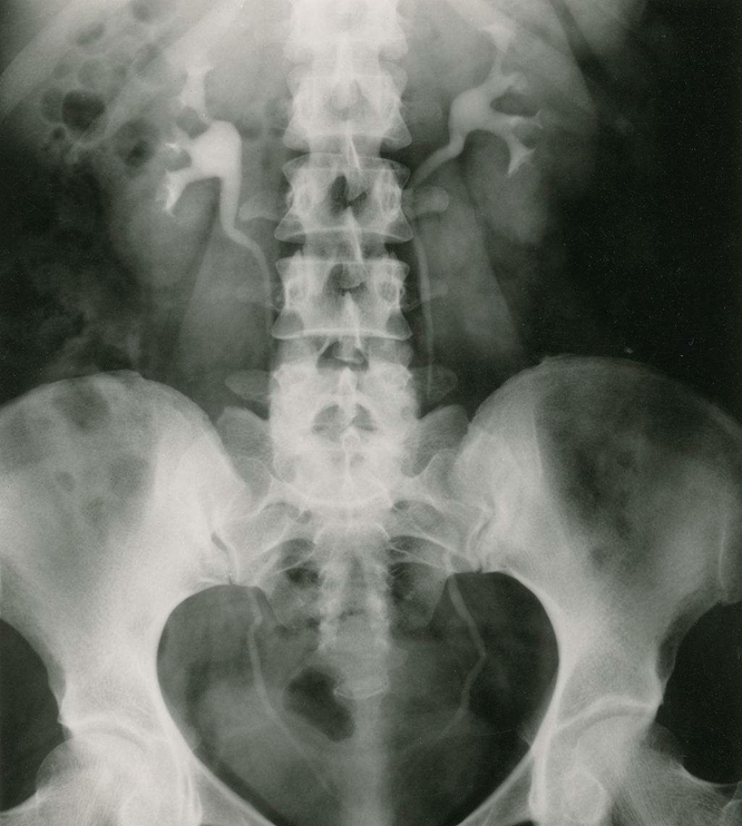 醫(yī)學(xué)影像學(xué)泌尿系統(tǒng)復(fù)習(xí)重點(diǎn)