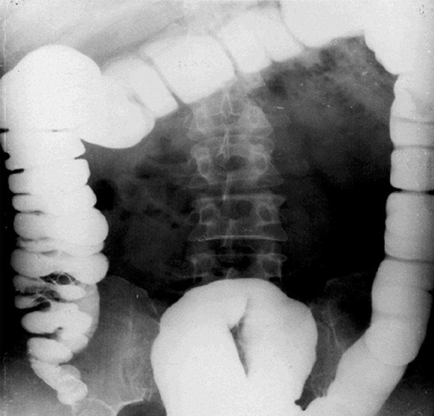 醫(yī)學(xué)影像學(xué)消化系統(tǒng)復(fù)習(xí)重點