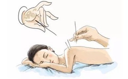 成都哪些衛(wèi)校有針灸推拿專業(yè)