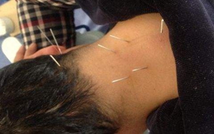 中醫(yī)針灸的分類