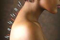 針灸減肥的誤區(qū)