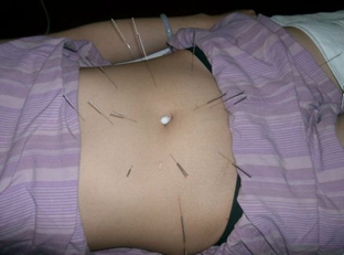 中醫(yī)針灸減肥