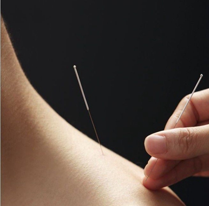 中醫(yī)針灸
